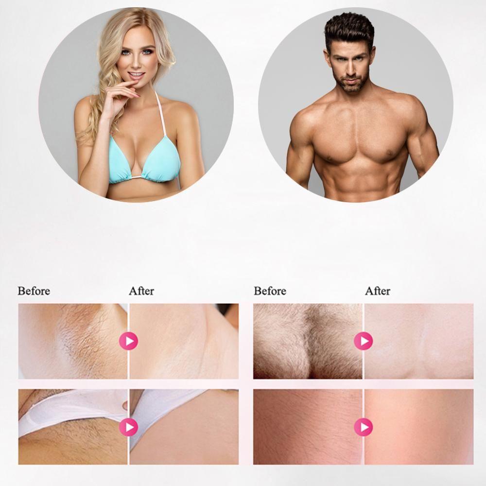 Professionell IPL Hårborttagare med Laser – Epilering Apparat