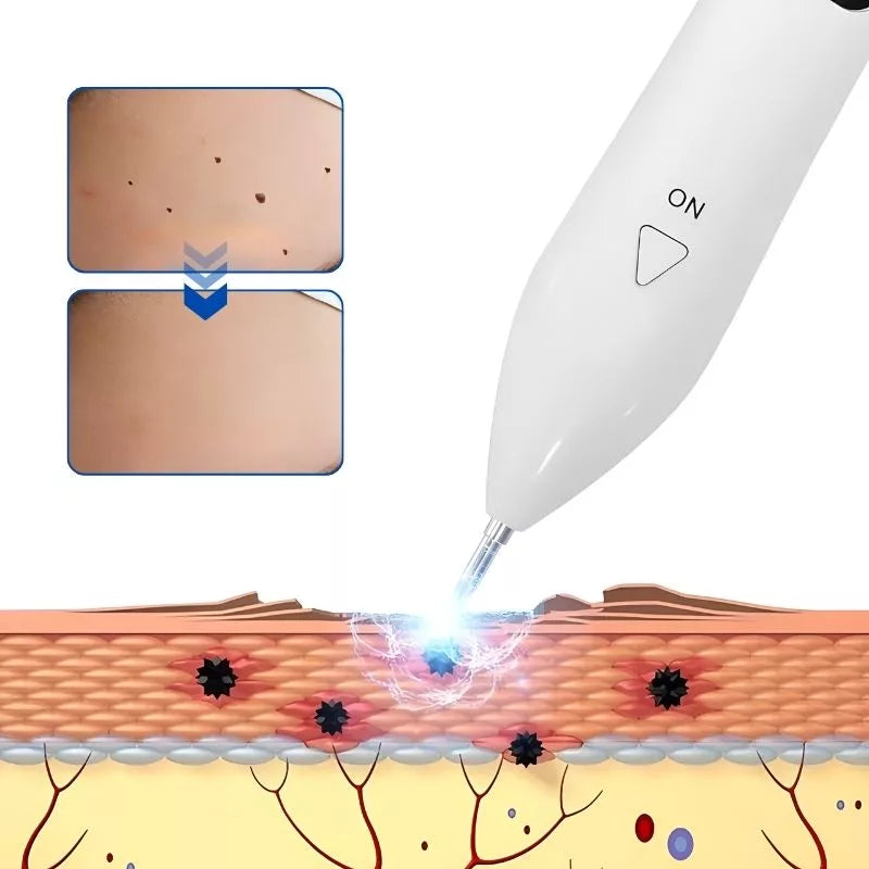 Effektiv Laser Plasma Pen til Hjemmebrug - Fjern Pigmentpletter