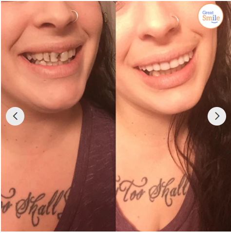 Naturlige Snap-On Tænder til Øjeblikkelig Perfekt Smil
