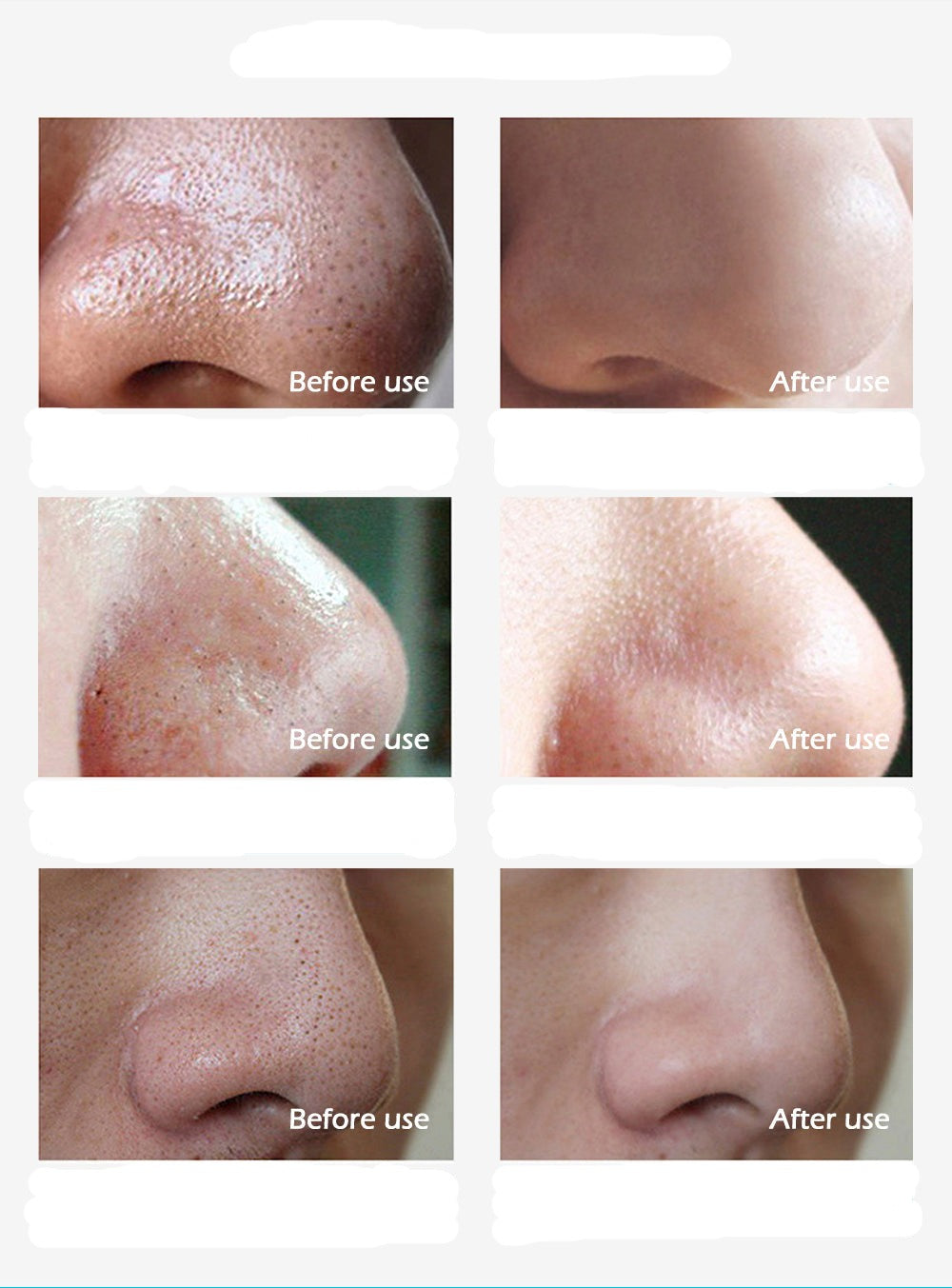 Fjern sorte prikker med ClearSkin