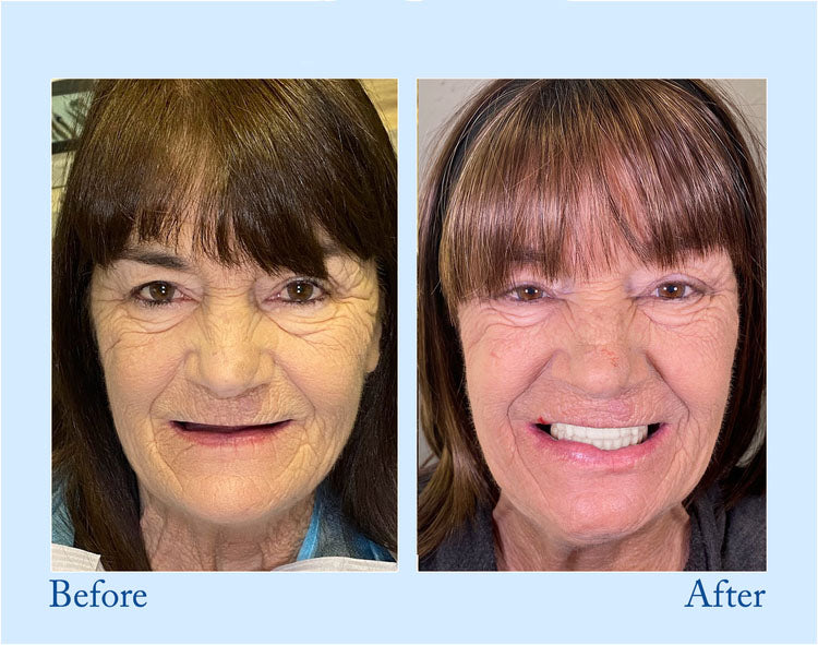 Vollprothese for Naturligt Smil – Smileasego