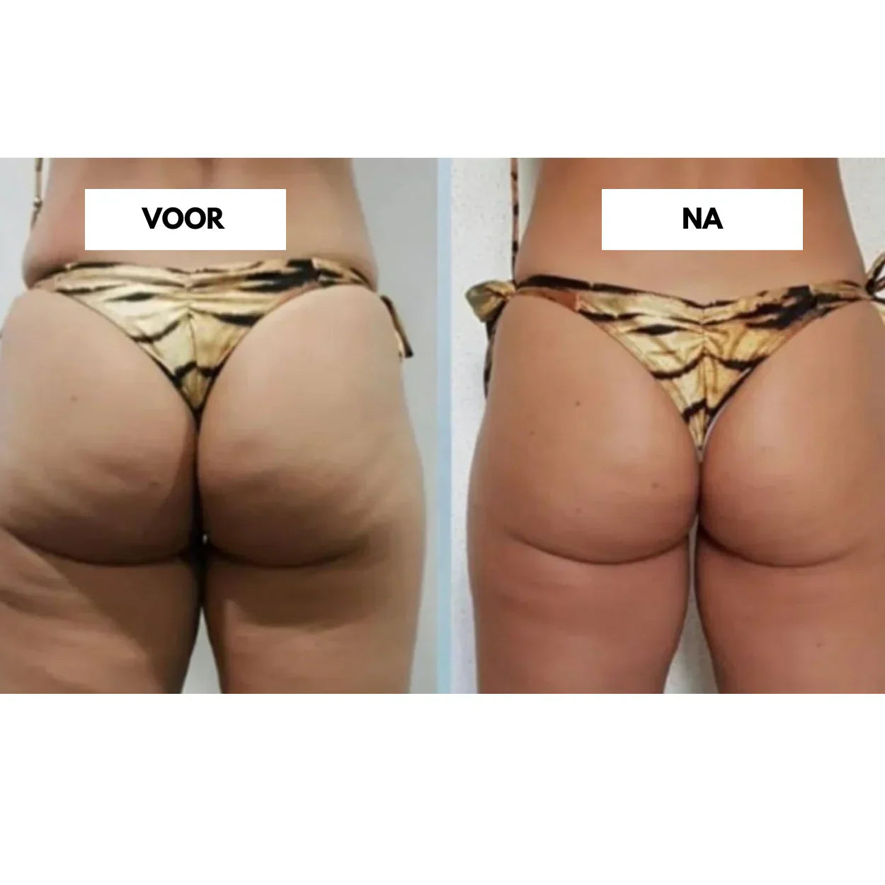 Effektiv vakuummassager til reduktion af cellulite