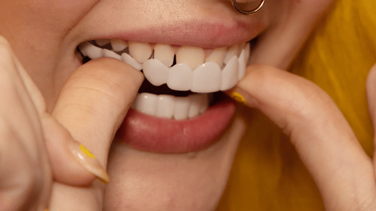 Omedelbart användbara Smile Veneers för ett Snyggt Leende