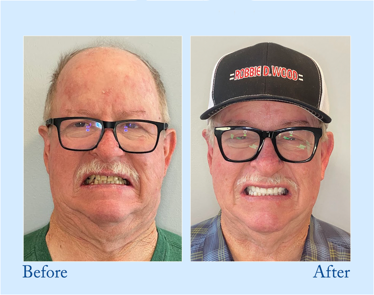 Vollprothese for Naturligt Smil – Smileasego