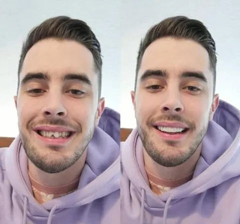 Strålande Smile Veneers för en perfekt tandrad