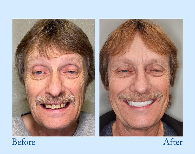 Vollprothese for Naturligt Smil – Smileasego
