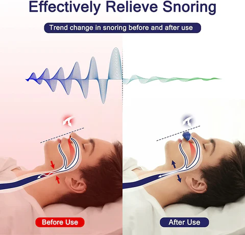 Mikro CPAP mod snorken | Behandling af søvnapnø uden maske