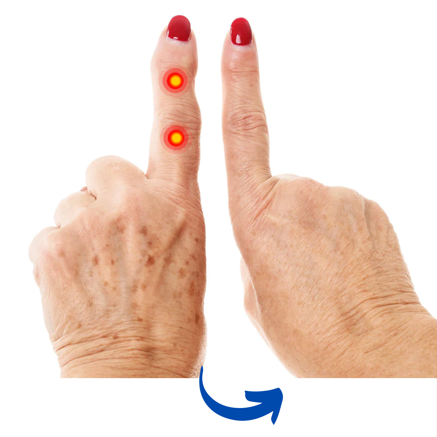 Ljusterapihandske för smärtlindring och förbättrad handfunktion