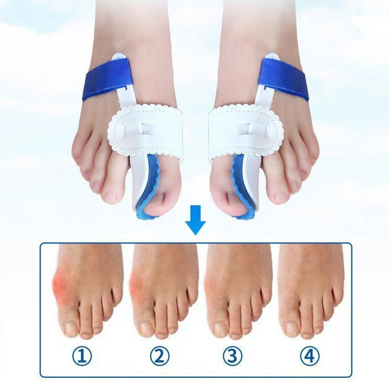 Effektiv nattkena för Hallux Valgus-korrigering