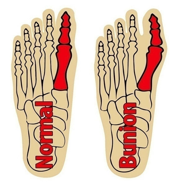 Effektiv Hallux Valgus-korrigerare – Komfort och Kvalitet i Fokus